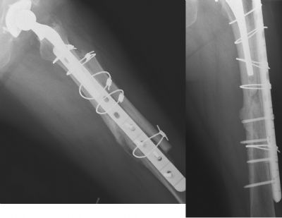 Intermedics Titanium Plate (Implant 23)